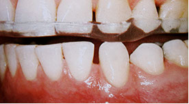 Zahnarztpraxis Dr. Isabel Selmair - München, Schwabing / Schienentherapie, Zähneknirschen