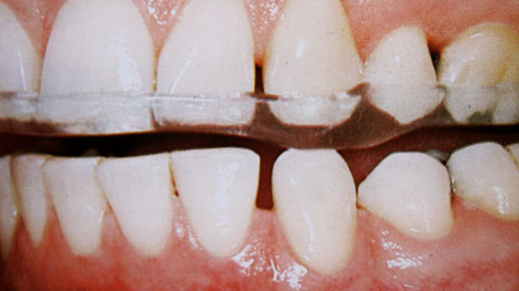 Zahnarztpraxis Dr. Isabel Selmair - München, Schwabing / Schienentherapie, Zähneknirschen