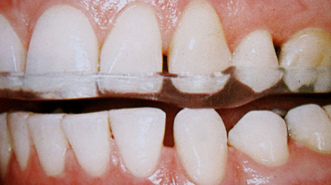 Zahnarztpraxis Dr. Isabel Selmair - München, Schwabing / Schienentherapie, Zähneknirschen