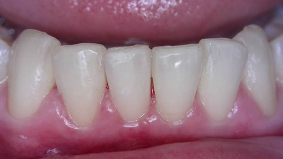 Zahnarztpraxis Dr. Isabel Selmair - München, Schwabing / Schienentherapie, Aligner Therapie