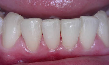 Zahnarztpraxis Dr. Isabel Selmair - München, Schwabing / Schienentherapie, Aligner Therapie