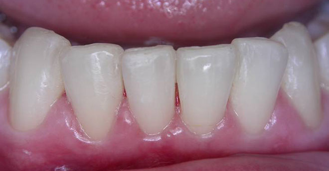 Zahnarztpraxis Dr. Isabel Selmair - München, Schwabing / Schienentherapie, Aligner Therapie