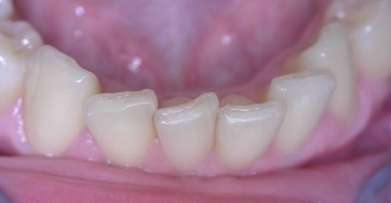 Zahnarztpraxis Dr. Isabel Selmair - München, Schwabing / Schienentherapie, Aligner Therapie