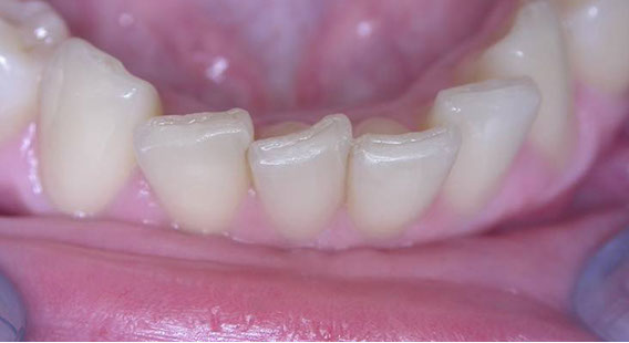 Zahnarztpraxis Dr. Isabel Selmair - München, Schwabing / Schienentherapie, Aligner Therapie