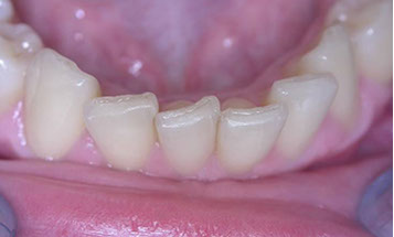 Zahnarztpraxis Dr. Isabel Selmair - München, Schwabing / Schienentherapie, Aligner Therapie