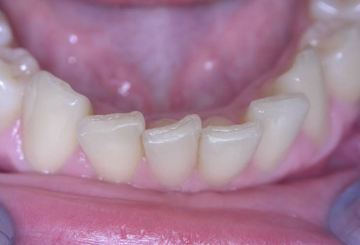 Zahnarztpraxis Dr. Isabel Selmair - München, Schwabing / Schienentherapie, Aligner Therapie