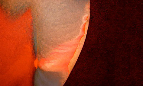 Zahnarztpraxis Dr. Isabel Selmair - München, Schwabing / Minimalinvasive Füllungstechniken, Karies