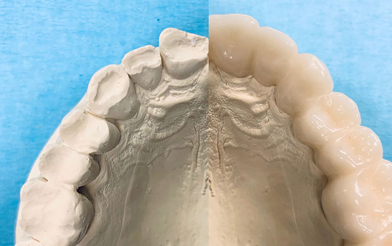 Zahnarztpraxis Dr. Isabel Selmair - München, Schwabing / Schienentherapie, Schienen