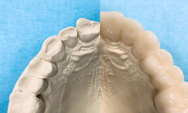 Zahnarztpraxis Dr. Isabel Selmair - München, Schwabing / Schienentherapie, Schienen