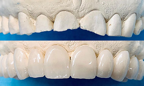 Zahnarztpraxis Dr. Isabel Selmair - München, Schwabing / Schienentherapie, Schienen