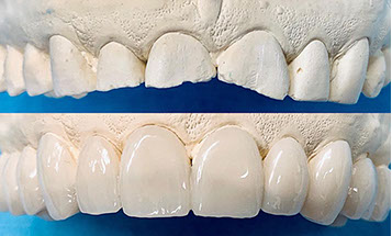 Zahnarztpraxis Dr. Isabel Selmair - München, Schwabing / Schienentherapie, Schienen