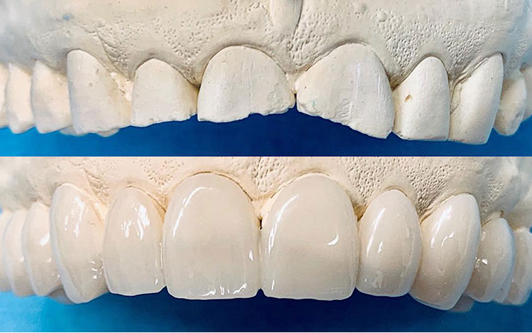 Zahnarztpraxis Dr. Isabel Selmair - München, Schwabing / Schienentherapie, Schienen