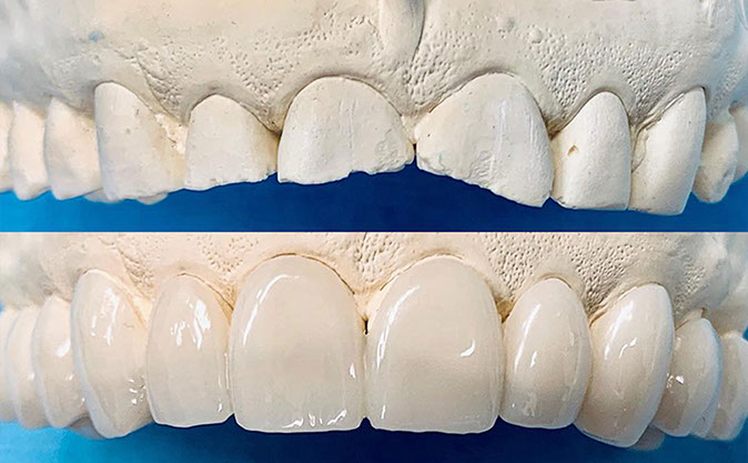 Zahnarztpraxis Dr. Isabel Selmair - München, Schwabing / Schienentherapie, Schienen