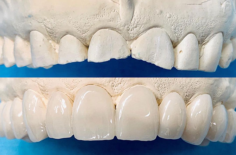 Zahnarztpraxis Dr. Isabel Selmair - München, Schwabing / Schienentherapie, Schienen