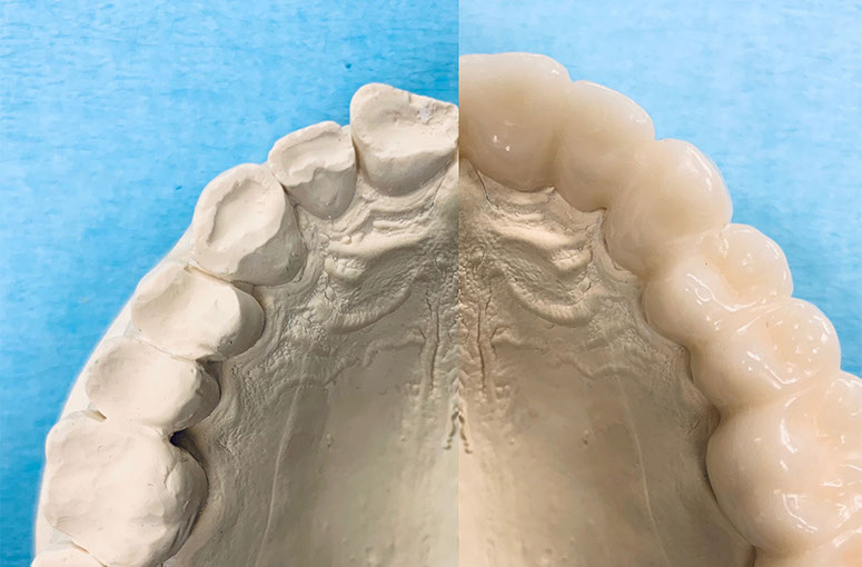 Zahnarztpraxis Dr. Isabel Selmair - München, Schwabing / Schienentherapie, Schienen