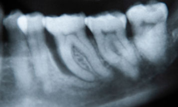 Zahnarztpraxis Dr. Isabel Selmair - München, Schwabing / Parodontitisbehandlung