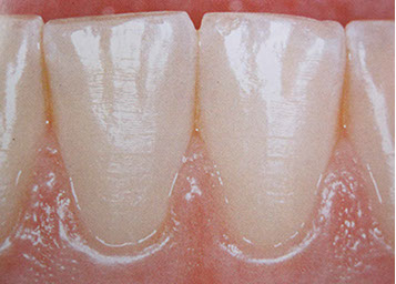 Zahnarztpraxis Dr. Isabel Selmair - München, Schwabing / Parodontitisbehandlung