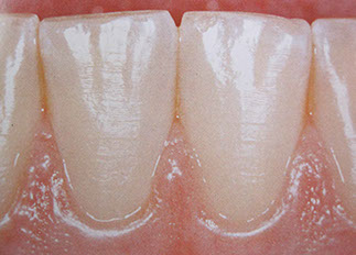 Zahnarztpraxis Dr. Isabel Selmair - München, Schwabing / Parodontitisbehandlung