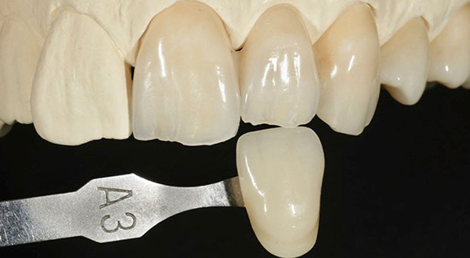 Zahnarztpraxis Dr. Isabel Selmair - München, Schwabing / Zahnersatz, Kronen Brücken