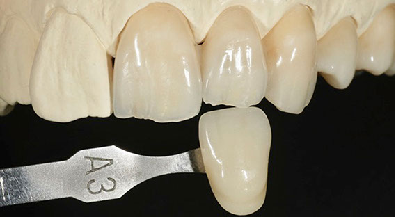 Zahnarztpraxis Dr. Isabel Selmair - München, Schwabing / Zahnersatz, Kronen Brücken