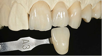 Zahnarztpraxis Dr. Isabel Selmair - München, Schwabing / Zahnersatz, Kronen Brücken