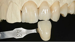 Zahnarztpraxis Dr. Isabel Selmair - München, Schwabing / Zahnersatz, Kronen Brücken