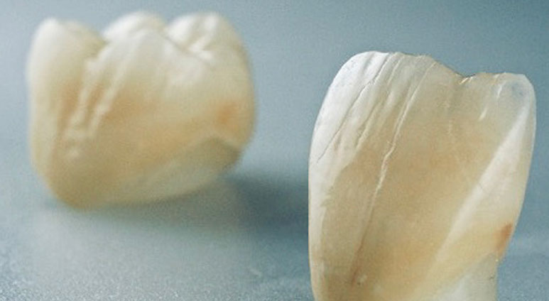 Zahnarztpraxis Dr. Isabel Selmair - München, Schwabing / Zahnersatz, Kronen Brücken