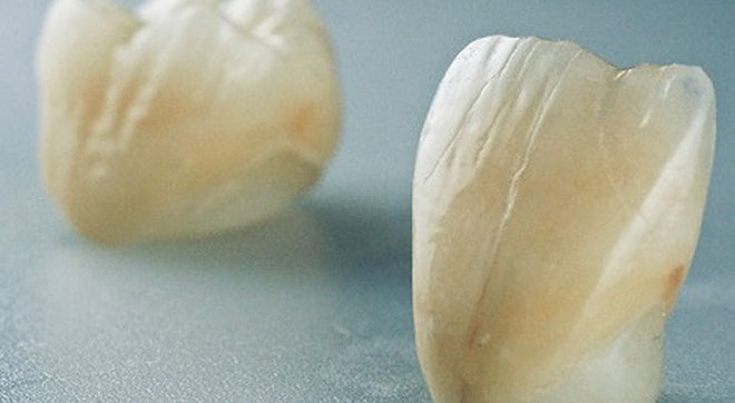 Zahnarztpraxis Dr. Isabel Selmair - München, Schwabing / Zahnersatz, Kronen Brücken