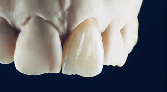 Zahnarztpraxis Dr. Isabel Selmair - München, Schwabing / Zahnersatz, Kronen Brücken