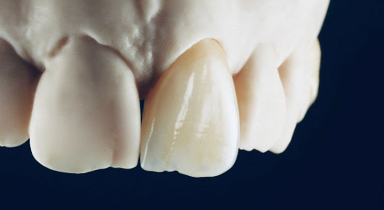 Zahnarztpraxis Dr. Isabel Selmair - München, Schwabing / Zahnersatz, Kronen Brücken