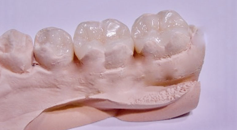 Zahnarztpraxis Dr. Isabel Selmair - München, Schwabing / Füllungen, Inlays