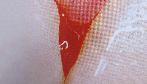 Zahnarztpraxis Dr. Isabel Selmair - München, Schwabing / Parodontitisbehandlung