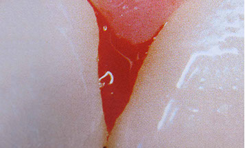 Zahnarztpraxis Dr. Isabel Selmair - München, Schwabing / Parodontitisbehandlung