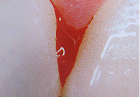 Zahnarztpraxis Dr. Isabel Selmair - München, Schwabing / Parodontitisbehandlung