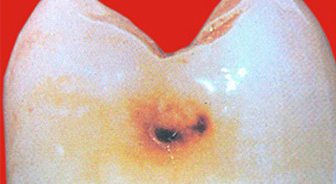 Zahnarztpraxis Dr. Isabel Selmair - München, Schwabing / Minimalinvasive Füllungstechniken, Karies