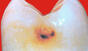 Zahnarztpraxis Dr. Isabel Selmair - München, Schwabing / Minimalinvasive Füllungstechniken, Karies