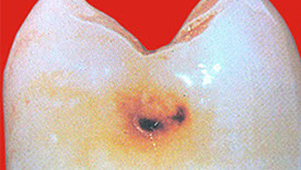 Zahnarztpraxis Dr. Isabel Selmair - München, Schwabing / Minimalinvasive Füllungstechniken, Karies