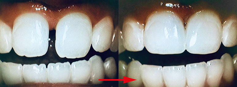 Zahnarztpraxis Dr. Isabel Selmair - München, Schwabing / Minimalinvasive Füllungstechniken, Korrekturen im Kunstoff