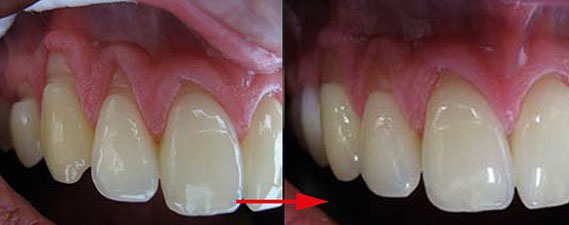 Zahnarztpraxis Dr. Isabel Selmair - München, Schwabing / Minimalinvasive Füllungstechniken, Korrekturen im Kunstoff