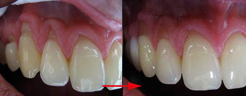 Zahnarztpraxis Dr. Isabel Selmair - München, Schwabing / Minimalinvasive Füllungstechniken, Korrekturen im Kunstoff