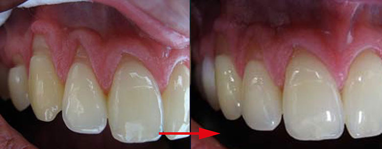 Zahnarztpraxis Dr. Isabel Selmair - München, Schwabing / Minimalinvasive Füllungstechniken, Korrekturen im Kunstoff