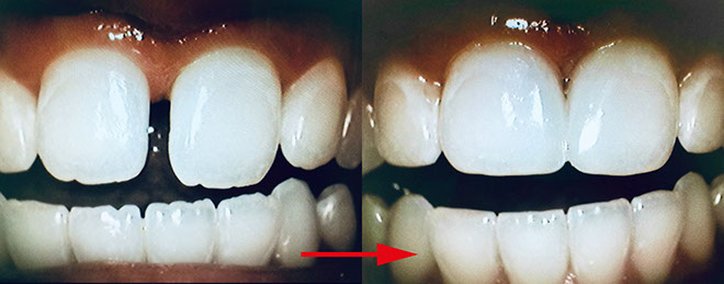 Zahnarztpraxis Dr. Isabel Selmair - München, Schwabing / Minimalinvasive Füllungstechniken, Korrekturen im Kunstoff