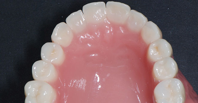 Zahnarztpraxis Dr. Isabel Selmair - München, Schwabing / Zahnersatz, Totalprothese