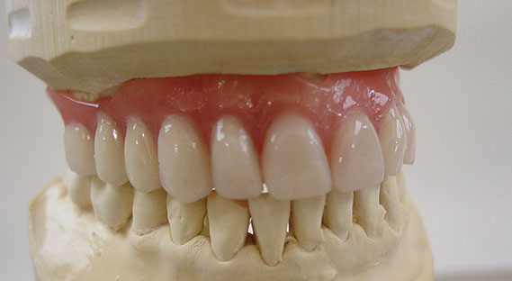 Zahnarztpraxis Dr. Isabel Selmair - München, Schwabing / Zahnersatz, Totalprothese