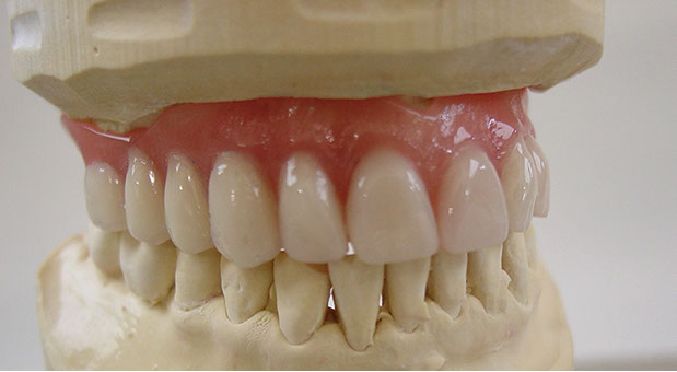 Zahnarztpraxis Dr. Isabel Selmair - München, Schwabing / Zahnersatz, Totalprothese