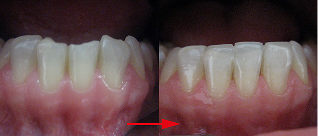 Zahnarztpraxis Dr. Isabel Selmair - München, Schwabing / Ästhetische Rekonstruktionen, Frontzahn