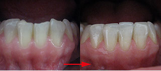 Zahnarztpraxis Dr. Isabel Selmair - München, Schwabing / Ästhetische Rekonstruktionen, Frontzahn