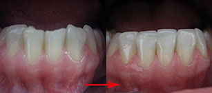Zahnarztpraxis Dr. Isabel Selmair - München, Schwabing / Ästhetische Rekonstruktionen, Frontzahn