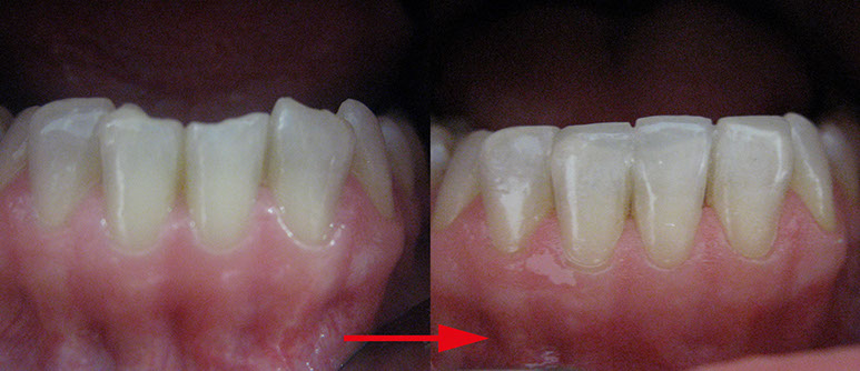 Zahnarztpraxis Dr. Isabel Selmair - München, Schwabing / Ästhetische Rekonstruktionen, Frontzahn