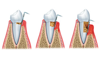 Zahnarztpraxis Dr. Isabel Selmair - München, Schwabing / Parodontitisbehandlung